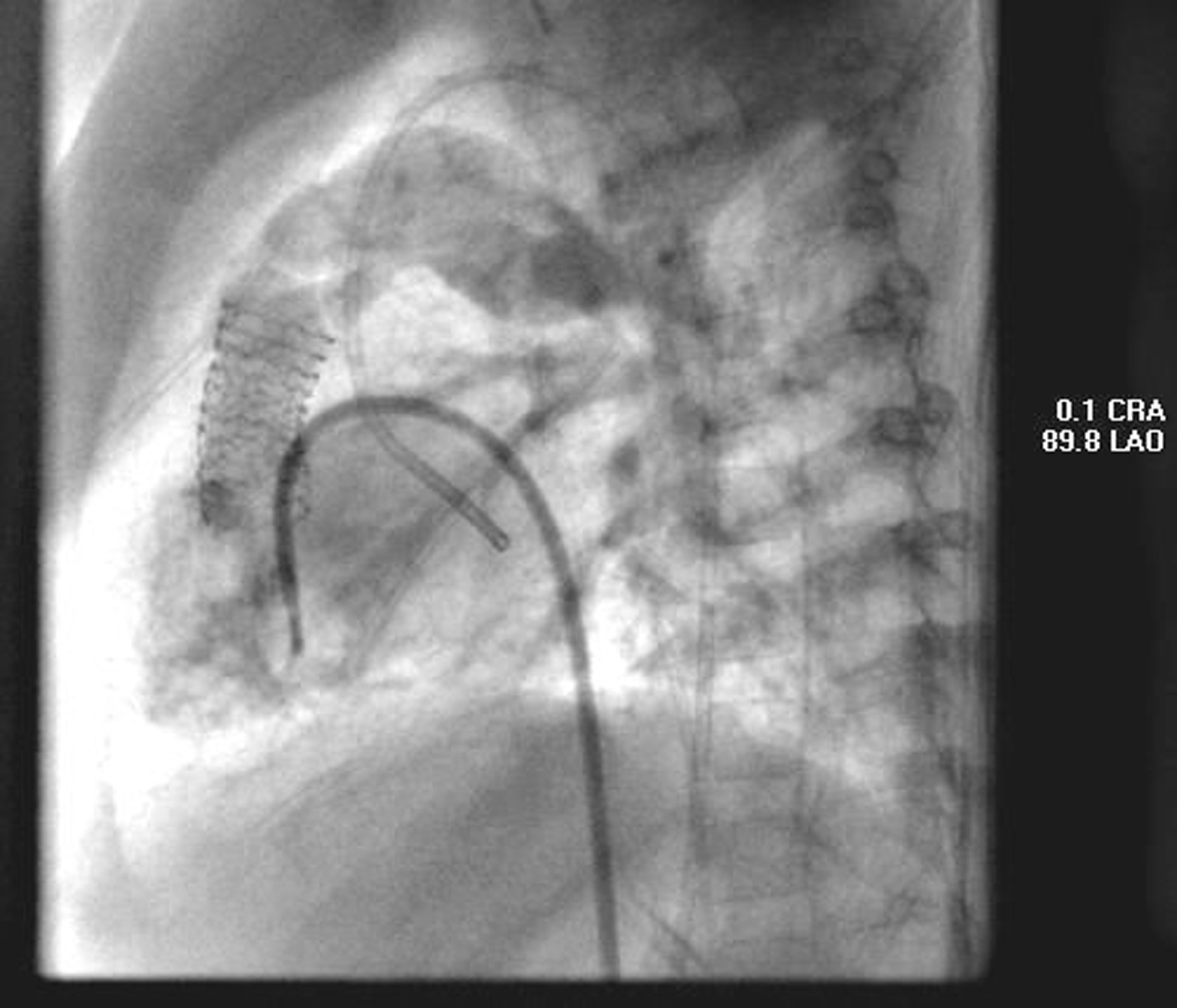 Right Ventricular Outflow Tract Stenting in Tetrology of Fallot with ...