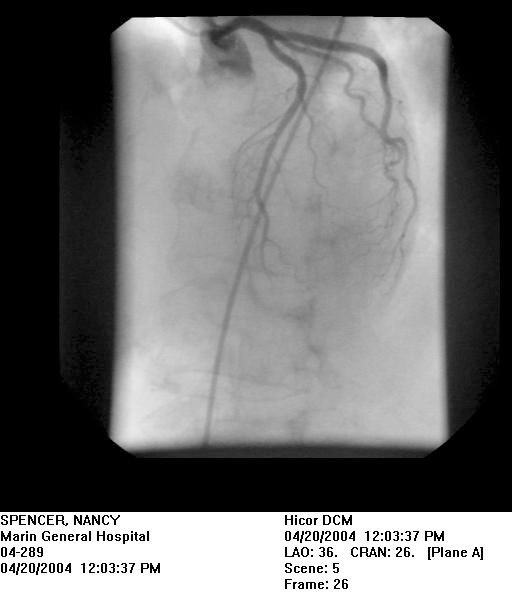 High Incidence Of Focal Left Ventricular Wall Motion Abnormalities And 
