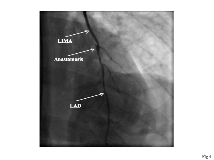Use of the PercuSurge GuardWire¬Æ Distal Balloon Occlusion System as an