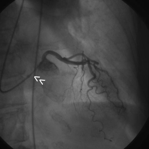 DoubleCatheter Technique for Catheterization of the Left Coronary Artery in a Patient with an