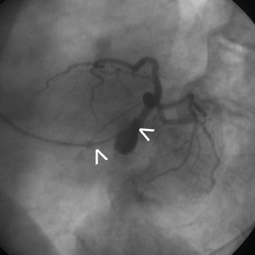 DoubleCatheter Technique for Catheterization of the Left Coronary Artery in a Patient with an
