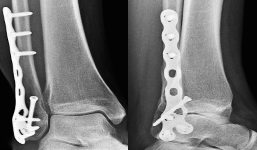 Locking Plates What Have We Learned?