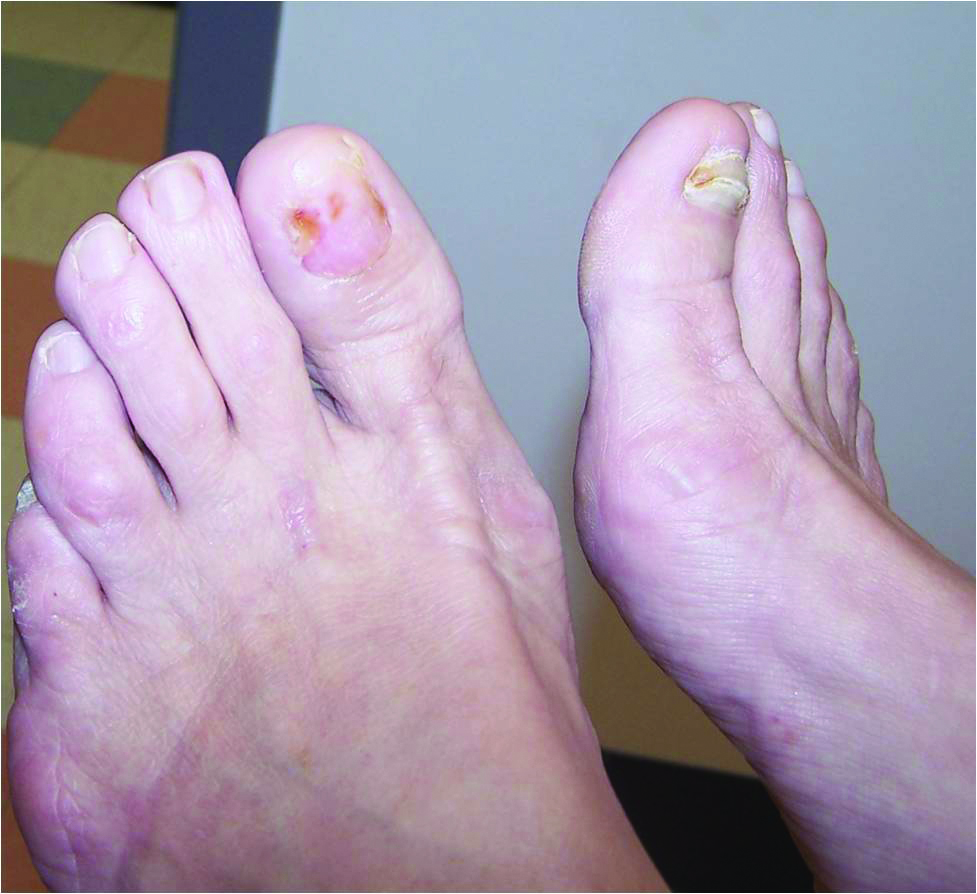How To Detect Nail Unit Tumors How To Detect Nail Unit Tumors