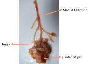 Isolated Dissection Of The Medial Calcaneal Nerve