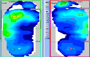 These pressure mapping images represent the athlete’s current orthotics. Note the higher green pressures under the lateral column bilaterally greater in the left than right. The left side was the injured side.