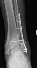 Here one can see a radiograph significant for osteomyelitis of not only the fibula but likely the distal tibia and talus as well. There is also complete destruction of the ankle joint.  