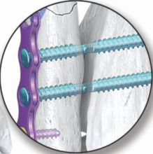 Gorilla Breakaway Screw System (Paragon 28)