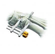 Lapiplasty Compressor (Treace Medical Concepts)