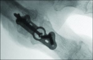 CoLink View Bone Plates