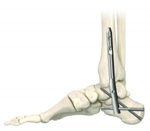 TriWay® TibioTaloCalcaneal (TTC) Nail Arthrodesis System