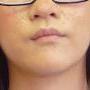 TUBEROUS SCLEROSIS COMPLEX 