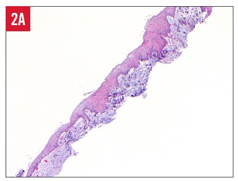 Gastric Signet-Ring Cell Carcinoma With Bladder Metastasis