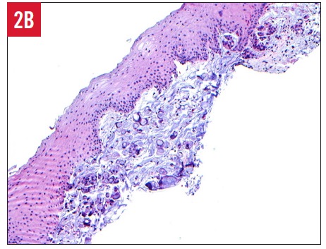 Gastric Signet-Ring Cell Carcinoma With Bladder Metastasis