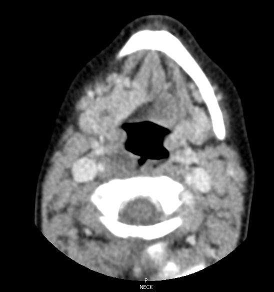 CT 1