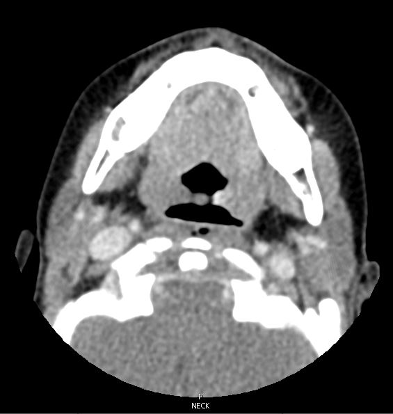 CT2