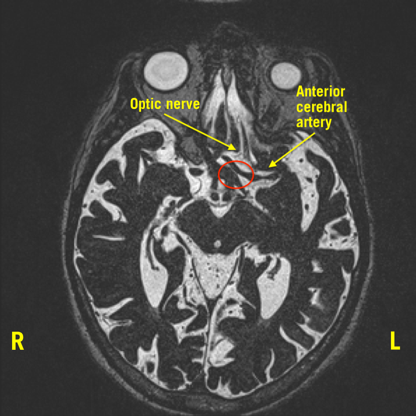 Neurovascular Compression of the Optic Nerve Causing Peripheral Vision Loss