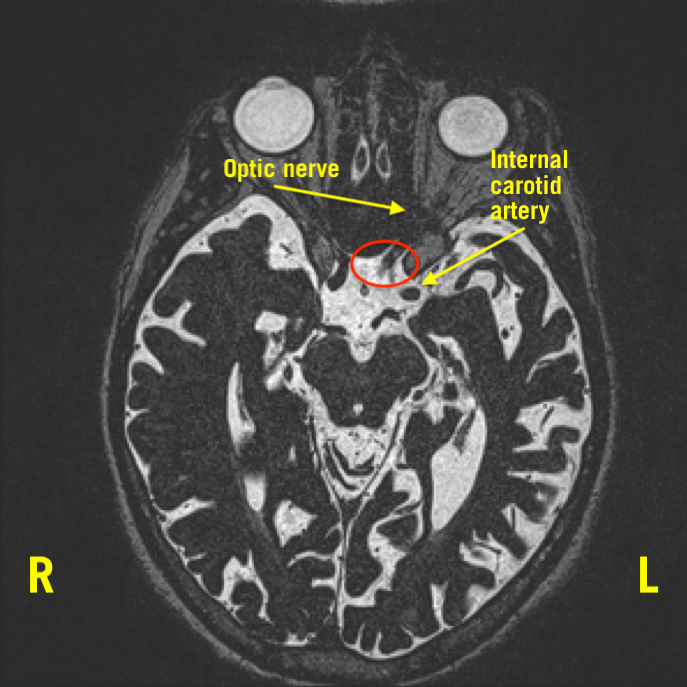 Neurovascular Compression of the Optic Nerve Causing Peripheral Vision Loss