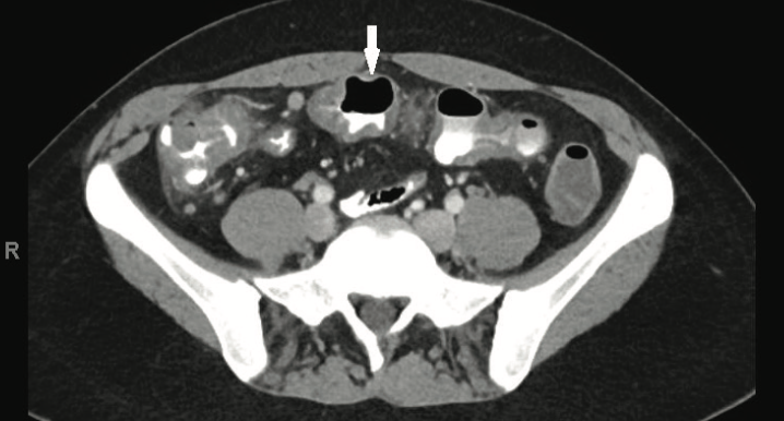 A Rare Case of Acute Colitis Caused by Methicillin-Resistant ...