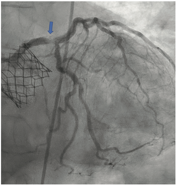 Nagaraja Intravascular Lithotripsy Figure 2