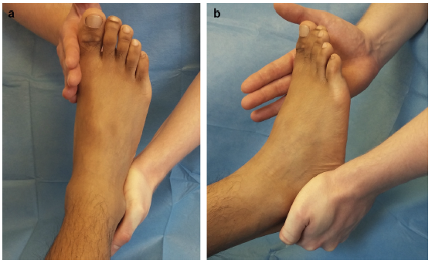 A Simple Test To Detect Spring Ligament Deficiency
