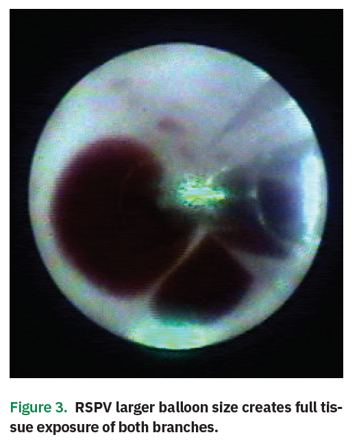 Direct Visualization, Speed, and Flexibility in Pulmonary Vein
