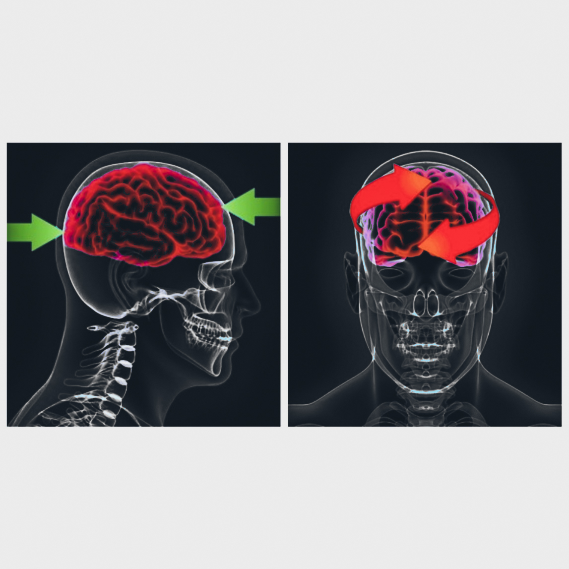 Linear impacts and rotational accelerations of the head 