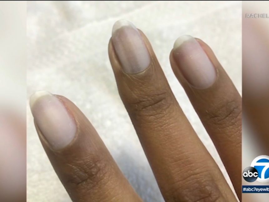 Green Nail Syndrome - American Osteopathic College of Dermatology (AOCD)