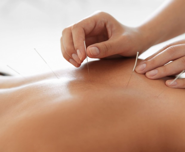 Session d'acupuncture