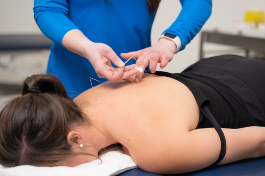 Acupuncture