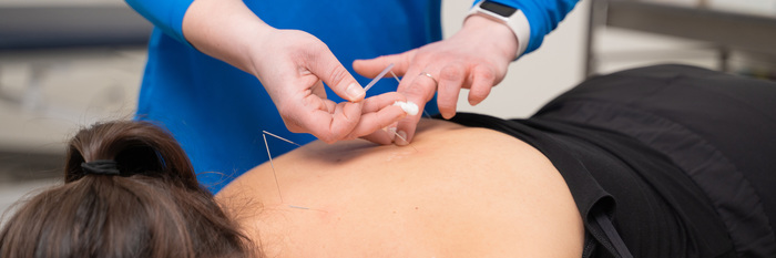 Acupuncture