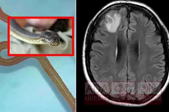 මිනිස් මොළයකින් වටපණුවෙක් හමුවෙයි