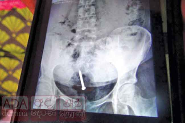 ගෘහ සේවිකාවකට කොන්ක්‍රීට් ඇණ ගිල්වූ සිද්ධියේ වාර්තාව හෙට