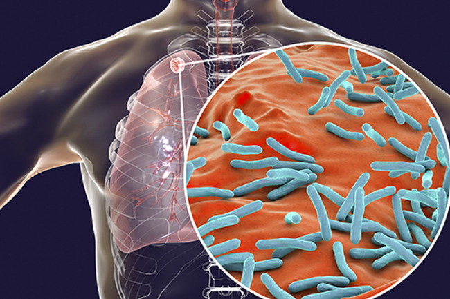 ක්ෂය රෝගය පිළිබඳව  WHO හෙළිදරව්වක්