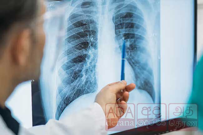 බස්නාහිර ක්ෂය රෝගීන් සියයට 45ක් - අවදානම් තැන් මෙන්න 