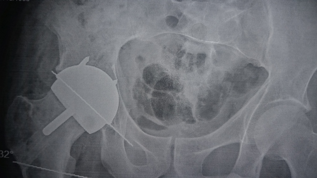 Motorcycle Riding after Hip Replacement Page 34 Adventure Rider