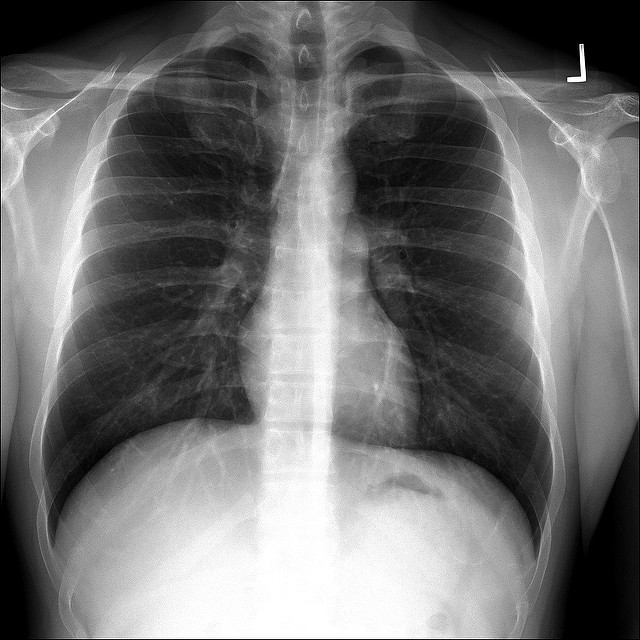 City sees third double lung transplant; a rarity in the West