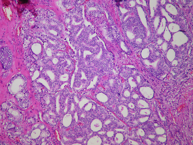 Study links inflammatory bowel disease to prostate cancer