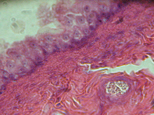 Tiny, implantable device may treat bladder problems