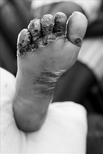 Rovisa's foot before having more than 100 jiggers removed.