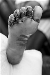 Rovisa's foot before having more than 100 jiggers removed.: by arielle, Views[347]