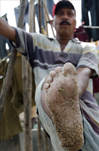Chemicals used to wash clothes usually damage skin's workers of the dhobi ghats; more over the hands and feet.