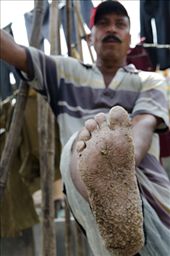 Chemicals used to wash clothes usually damage skin's workers of the dhobi ghats; more over the hands and feet.: by danielsordo, Views[1054]
