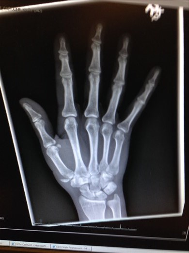 X-ray showing the fracture to the base of the thumb (chipped off piece of bone)