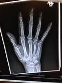 X-ray showing the fracture to the base of the thumb (chipped off piece of bone): by drfrenchie, Views[709]