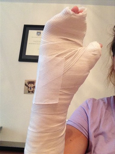 Massive cast post-op