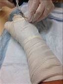 Removing the cast so I can be fitted with a more suitable splint : by drfrenchie, Views[257]