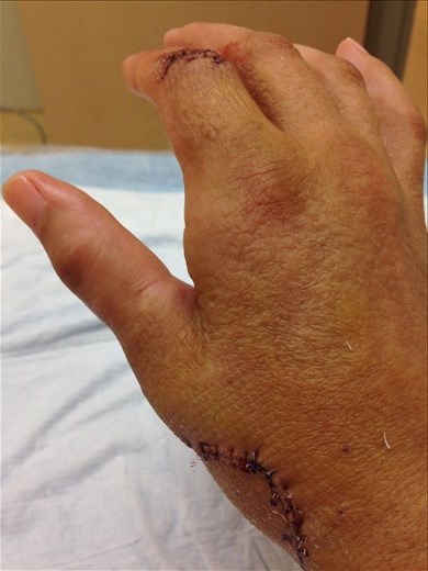 My thumb is at a funky angle but should correct itself after lots of physio (so they tell me)