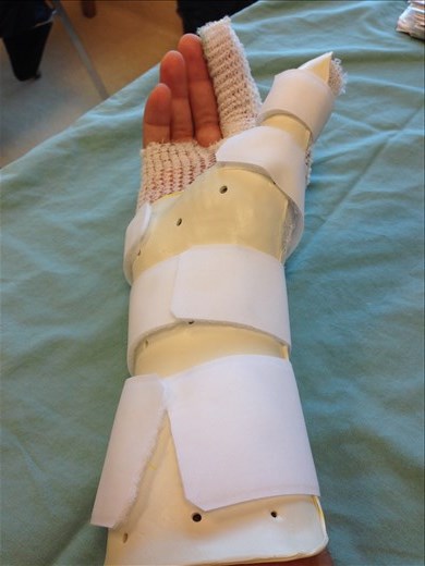 My new bionic hand :) 
