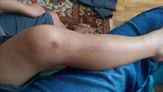 Also scooter crashes! Tough life ;)