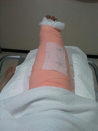 My elephant foot after my operation